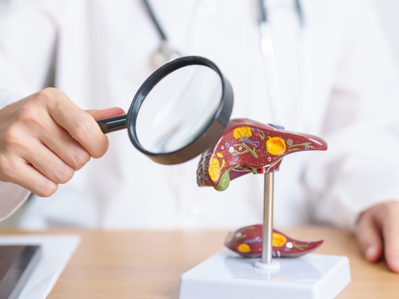 Doctor with human Liver model and Magnifying glass. Liver cancer and Tumor, Jaundice, Viral Hepatitis A, B, C, D, E, Cirrhosis, Failure, Enlarged, Hepatic Encephalopathy and Ascites Fluid in Belly
